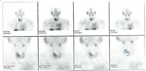 Technetium M Sestamibi Parathyroid Scan The Scan Shows Focal Area Of