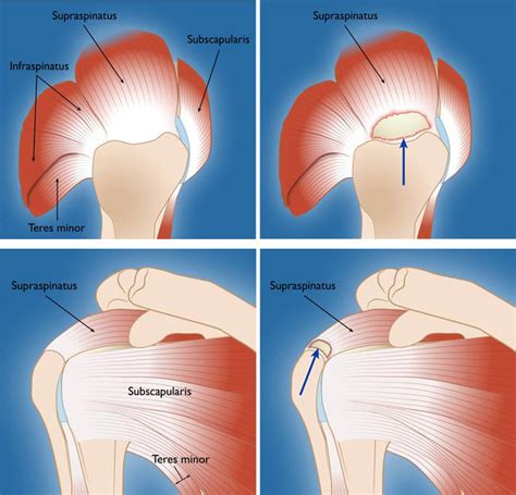 Chris Treat, D.O. | Rotator Cuff Tear - Patient Education