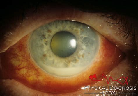 Hypopyon - Physical Diagnosis PDX