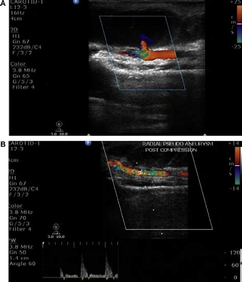 E A Color Doppler Ultrasound Demonstrates A Pseudoaneurysm Of The Download Scientific Diagram