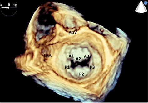 Three Dimensional 3d Echocardiography Kardiohirurgijars