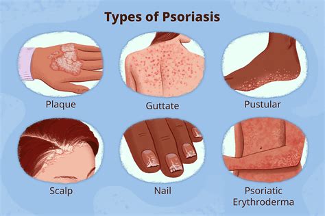 Understanding Psoriasis Causes Types And Symptoms A Comprehensive Guide