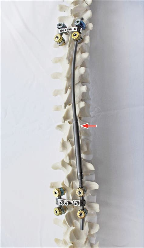 Magnetically Controlled Growing Rods For Severe Spinal Curvature In