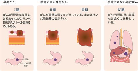 胃がん 各がんの解説 がん診療情報｜大阪赤十字病院