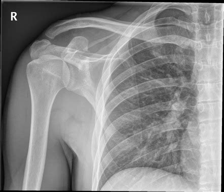 Coracoid process fracture | Radiology Case | Radiopaedia.org