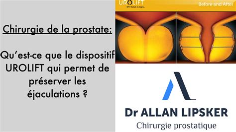 Urolift Traiter L Ad Nome De La Prostate Tout En Pr Servant Les