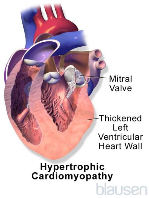 Image Hypertrophic Cardiomyopathy Msd Manual Consumer Version