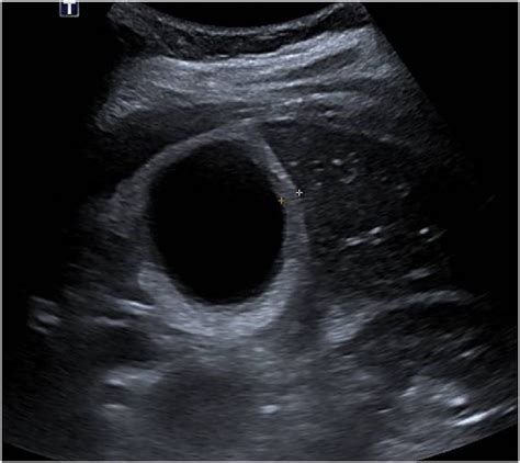 Gallbladder Ultrasound Transverse Hot Sex Picture