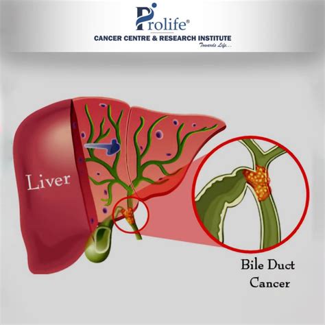 What Are Signs And Symptoms Of Bile Duct Cancer Prolife Cancer Centre