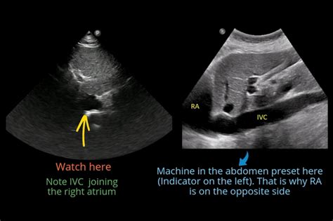 Focused Cardiac Ultrasound For The Nephrologist The Subxiphoid View