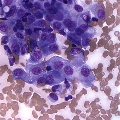 Mesenchymal Tumors Eclinpath