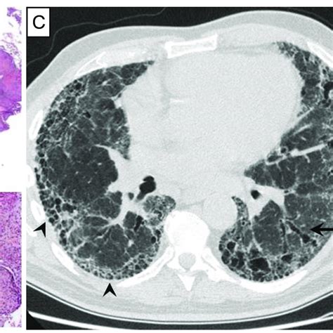 18 Typical Histological Findings Of Pulmonary Sarcoidosis A Compact Download Scientific