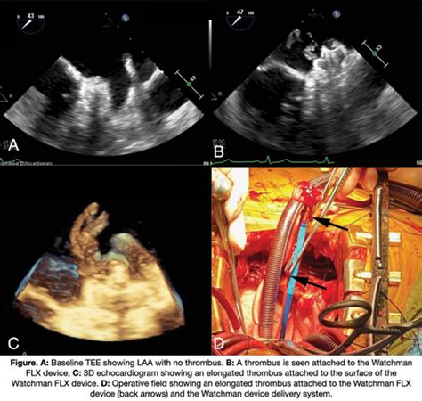 Acute Device Related Thrombus Formation During Implantation Of A