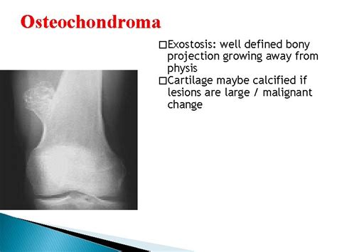 Radiology Of Bone Tumors Xrays The Question Need