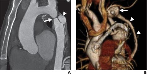 Figure 14—29 from CT and MRI of aortic coarctation: pre- and ...