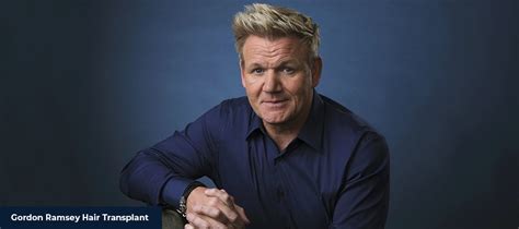 Chef Gordon Ramsay Hair Transplant - Smile Hair Clinic