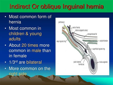 Inguinal Hernias Direct And Indirect Inguinal Hernias