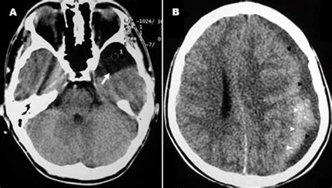 Middle Fossa Arachnoid Cyst