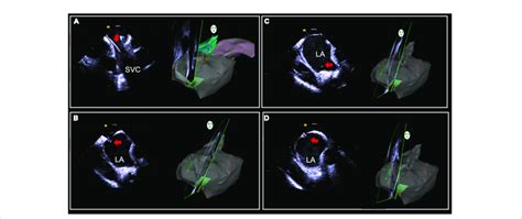 Intracardiac Ice Guided Zero X Ray Transseptal Puncture A