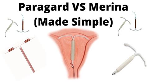 Birth Control Implants Paragard Vs Mirena Youtube