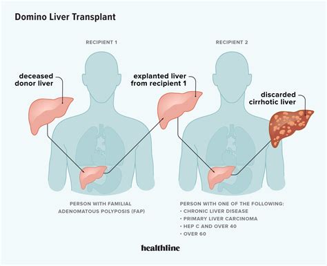 Domino Liver Transplant Benefits Procedure Outlook And More