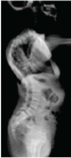 Ag Clavicular Hypoplasia Widened Pubic Symphysis Bilateral Coxa