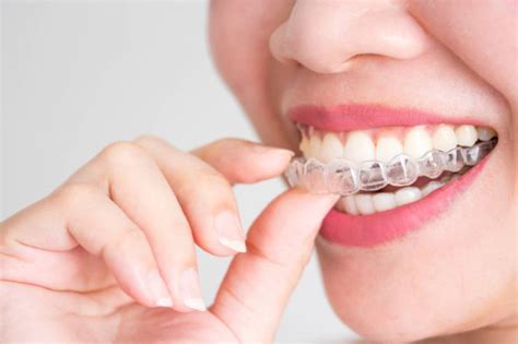 Cuánto dura el tratamiento de ortodoncia con Invisalign