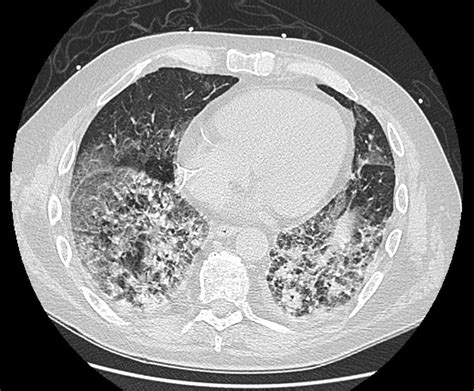 Interstitial Lung Disease Caused By Oxaliplatin An Uncommon But Not