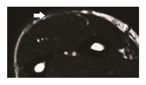 A patient with linear morphea before (a) and after (b) treatment. MRI ...