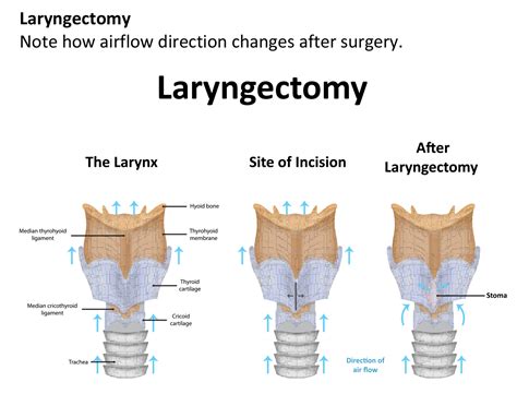 Types Of Laryngectomy