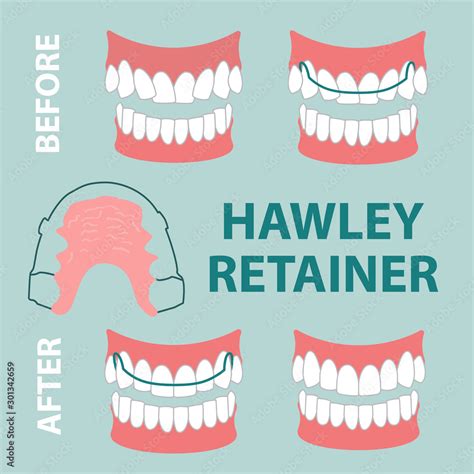 Vector Illustration Hawley Retainer Before And After Stock Vector