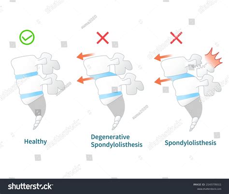 Illustration Spondylolisthesis Symptoms Stock Vector (Royalty Free ...