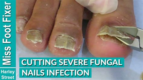 Cutting Severe Fungal Nails Infection By Miss Foot Fixer Marion Yau