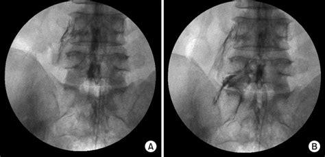 Epidural Neuroplasty Fluoroscopic Anterioposterior View A Left L5 Download Scientific