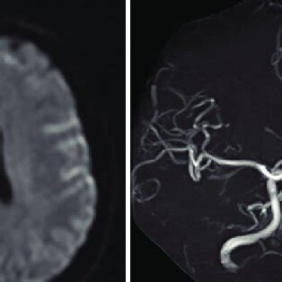 A A Follow Up Magnetic Resonance Image Revealing Minimal