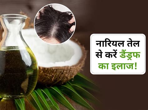 How To Use Coconut Oil For Dandruff In Hindi डैंड्रफ को जड़ से हटाने के लिए नारियल तेल में