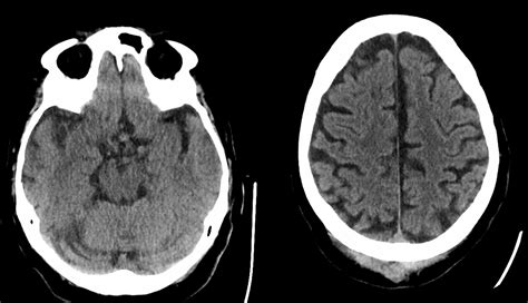 Missed Aneurysm Noncontrast Head CT Neuroangio Org