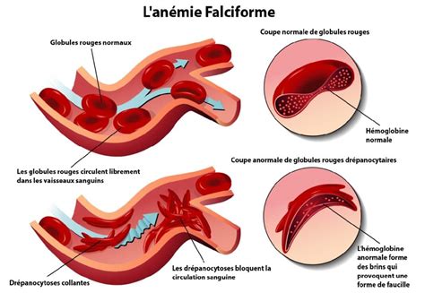 La drépanocytose SS SC et les porteurs sains causes symptômes et