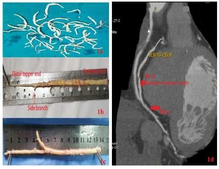 Photograph illustrate coronary atheroma. (Ia) Collected specimen of ...