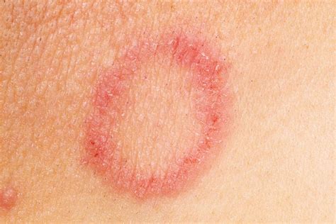 Skin Rashes In Children Nidirect