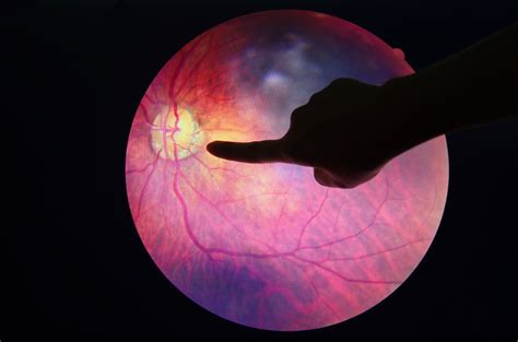 Lupus Eye Damage May Provide a Window Into Disease Activity