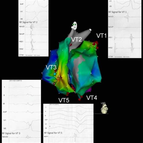 Electroanatomical Mapping With The CARTO System Composite RV And LV