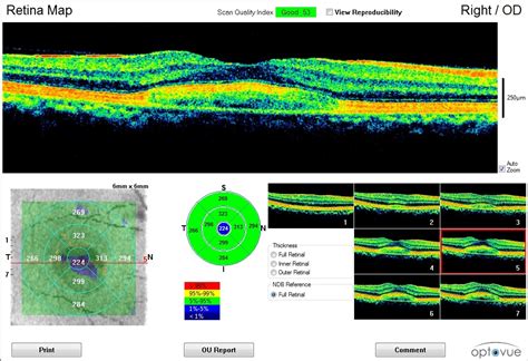 Blog Adult Onset Vitelliform Dystrophy - Prime Retina Eye Care Centre ...