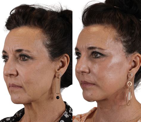 Deep Plane Facelift Scottsdale And Phoenix Az