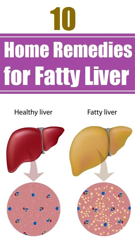 Top 10 Home Remedies For Fatty Liver Health Home Health Remedies Top 10 Home Remedies