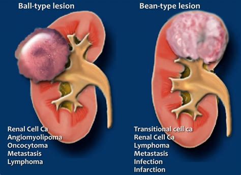 Mass Between Kidney And Spleen