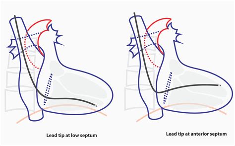 pacemaker drawing  getdrawings