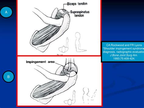 Ppt Rehabilitaci N De Hombro Y S Ndrome Del Pinzamiento Subacromial