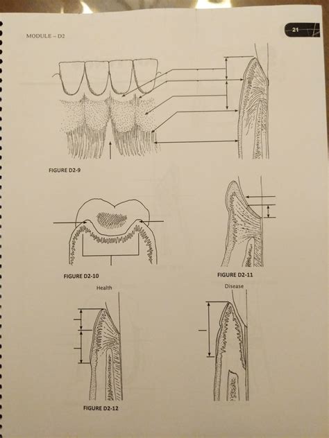 gingiva lecture 2 Diagram | Quizlet