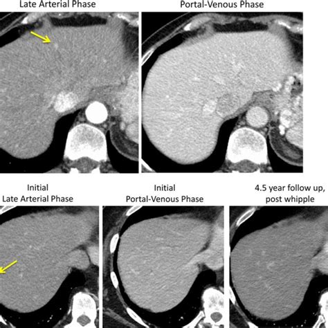 Liver Lesions Causes